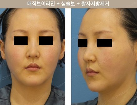 매직브이라인 + 심술보 + 팔자지방제거