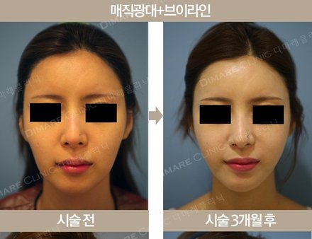 매직 광대 + 매직 브이라인