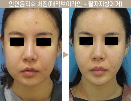 안면윤곽후 처짐(매직브이라인 + 팔자지방제거)