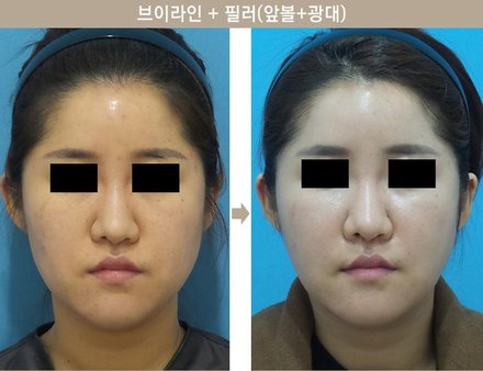 브이라인 + 필러(앞볼+광대)