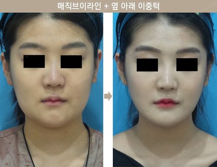 매직브이라인 +  옆 아래 이중턱