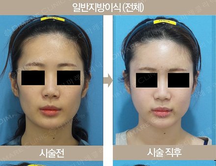 일반지방이식 (전체)