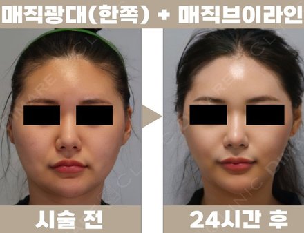 매직 광대(한쪽) + 매직 브이라인