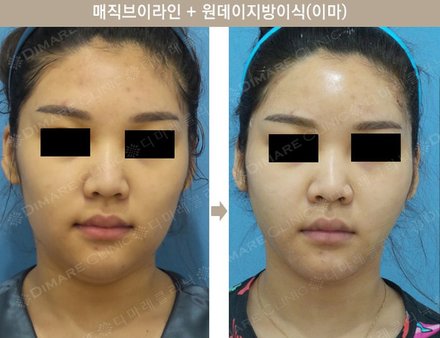 매직브이라인 + 원데이지방이식(이마)