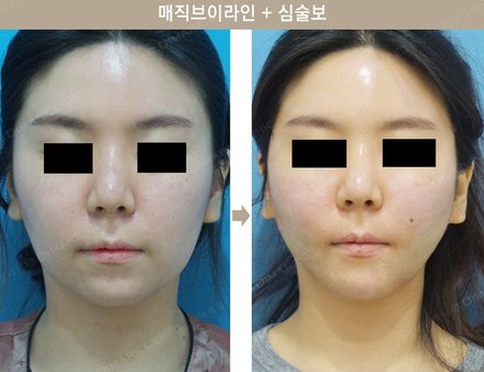 매직브이라인 + 심술보