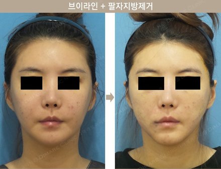 브이라인 + 팔자지방제거