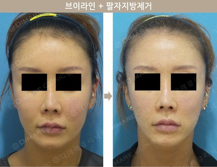 브이라인 + 팔자지방제거