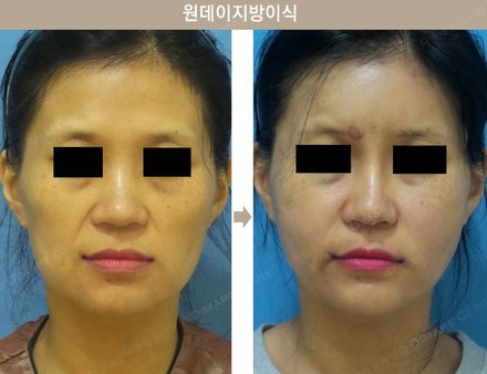 원데이지방이식