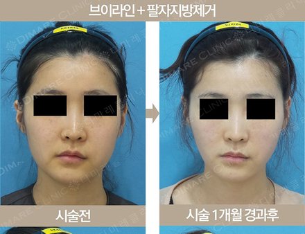 브이라인 + 팔자지방제거