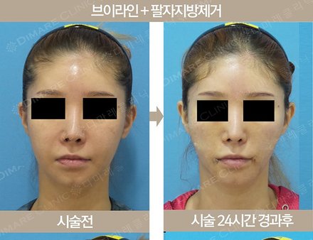 브이라인 + 팔자지방제거