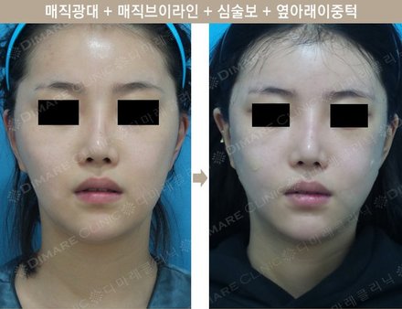 매직광대 + 매직브이라인 + 심술보 + 옆 아래 이중턱