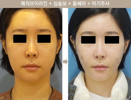 매직브이라인 + 심술보 + 울쎄라 + 아기주사