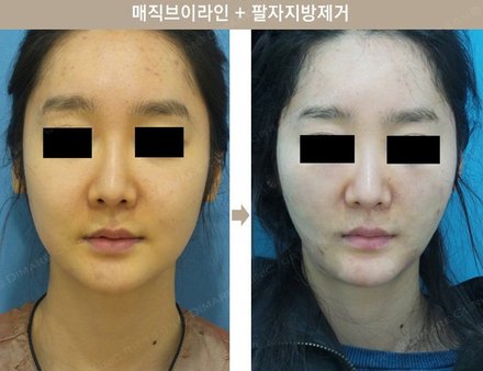 매직브이라인 + 팔자지방제거