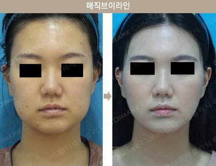 매직브이라인
