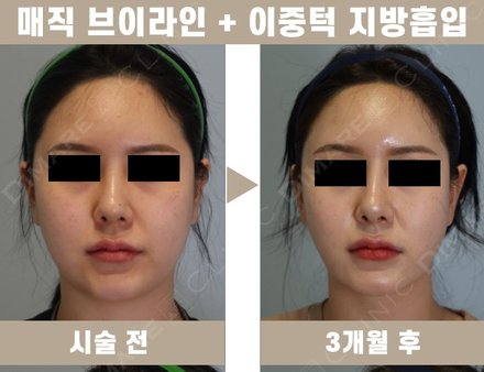 매직브이라인 + 이중턱 지방흡입