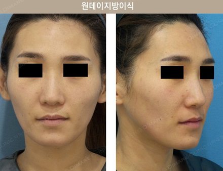 원데이지방이식