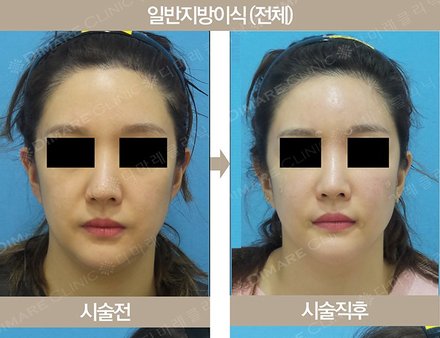 일반지방이식 (전체)