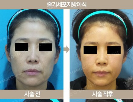 줄기세포 지방이식