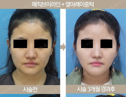 매직브이라인 + 옆아래이중턱