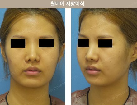 원데이지방이식