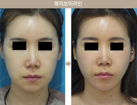 매직브이라인