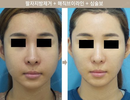 팔자지방제거 + 매직브이라인 + 심술보
