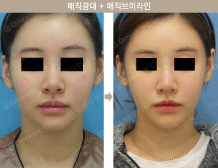 매직광대 + 매직브이라인