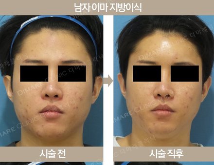 남자 이마 지방이식