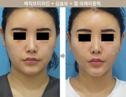 매직브이라인 + 심술보 + 옆 아래 이중턱