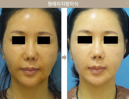 원데이지방이식
