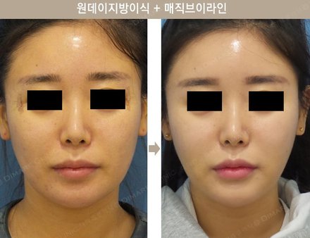 원데이지방이식 + 매직브이라인