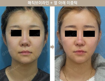 매직브이라인 + 옆 아래 이중턱
