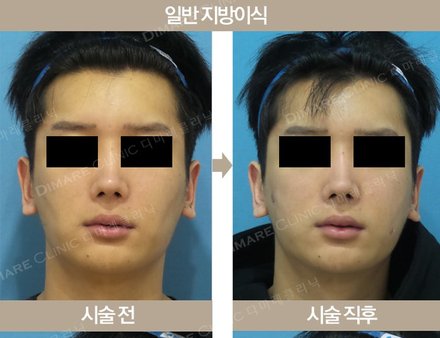 남자일반지방이식