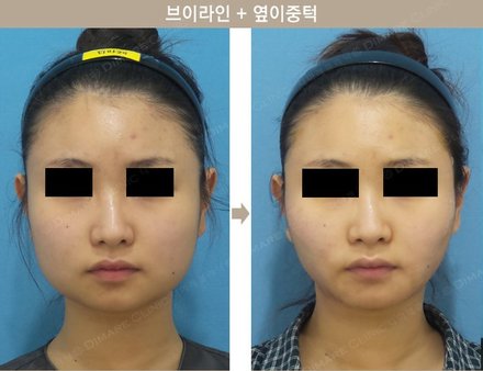 브이라인 + 옆이중턱