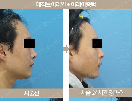 매직브이라인 + 아래이중턱