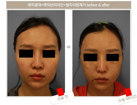 매직광대+브이라인+팔자지방제거