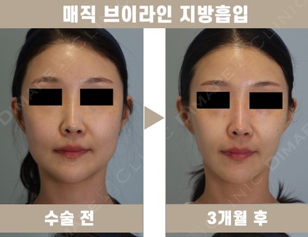 매직브이라인 지방흡입