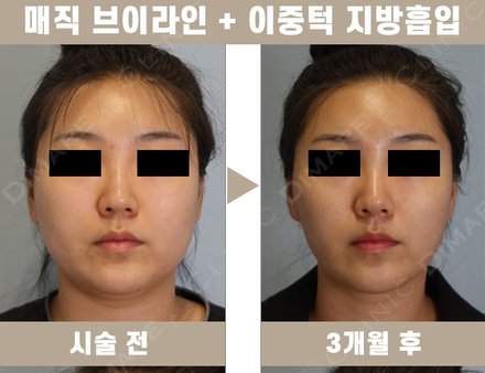 매직브이라인 + 이중턱 지방흡입