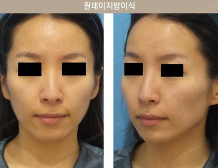 원데이지방이식