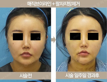 매직브이라인 + 팔자지방제거