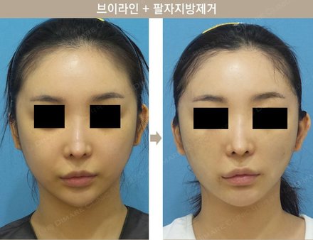 브이라인 + 팔자지방제거