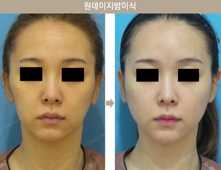 원데이지방이식