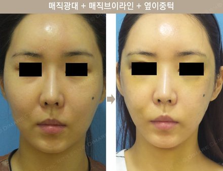 매직광대 + 매직브이라인 + 옆이중턱