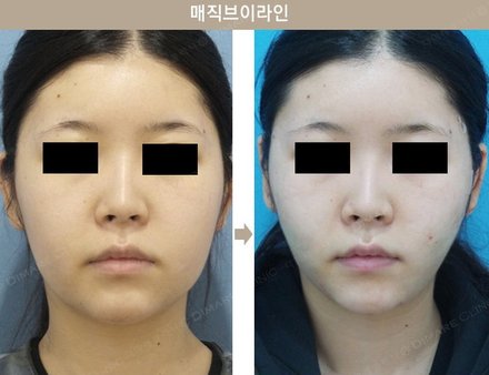 매직브이라인