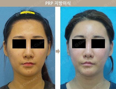 PRP 지방이식