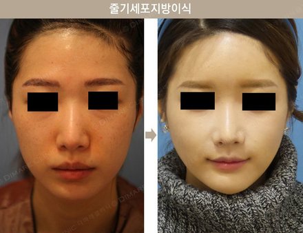 원데이지방이식