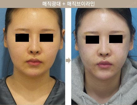 매직광대 + 매직브이라인