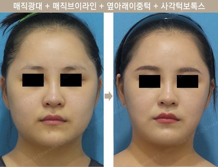 매직광대 + 매직브이라인 + 옆아래이중턱 + 사각턱보톡스