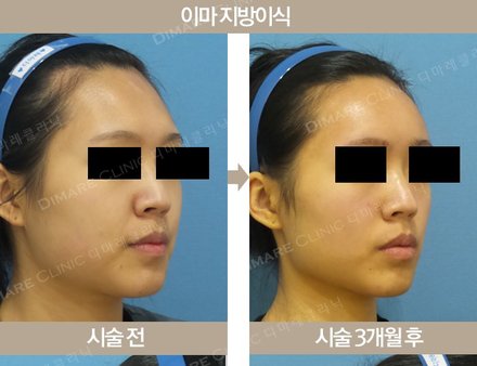 지방이식(이마)