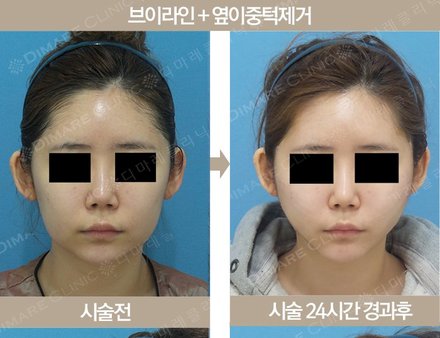 브이라인 + 옆이중턱제거